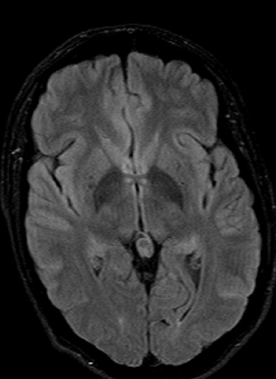 pineal-gland-mri